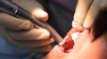 Dentist Grinds Tooth Of A Patient A Flexible Round Nozzle With Diamond Coating