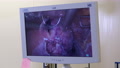 Uterine Suturing After Surgery To Remove Fibroids On Control Monitor Screen