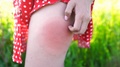 Allergic Reaction On Woman's Leg After Bee Sting. Girl Scratching Bite