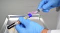 Medical Doctor Separating Layers Of Blood Platelet Rich Plasma Prp White
